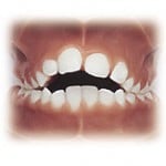 Orthodontic braces in black rock